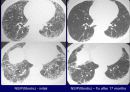 Idiopathic Interstitial Pneumonia 30페이지