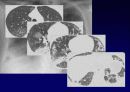 Idiopathic Interstitial Pneumonia 38페이지