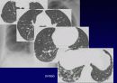 Idiopathic Interstitial Pneumonia 39페이지