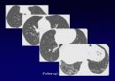 Idiopathic Interstitial Pneumonia 40페이지