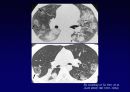 Idiopathic Interstitial Pneumonia 41페이지