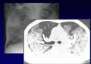 Idiopathic Interstitial Pneumonia 48페이지