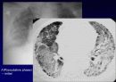 Idiopathic Interstitial Pneumonia 49페이지