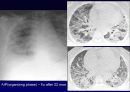 Idiopathic Interstitial Pneumonia 50페이지