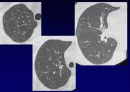 Idiopathic Interstitial Pneumonia 56페이지