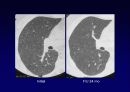 Idiopathic Interstitial Pneumonia 57페이지