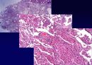 Idiopathic Interstitial Pneumonia 62페이지