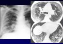 Idiopathic Interstitial Pneumonia 64페이지
