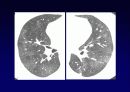 Idiopathic Interstitial Pneumonia 65페이지