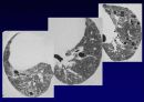 Idiopathic Interstitial Pneumonia 70페이지