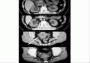 urolithiasis.ppt 20페이지