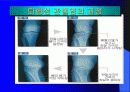 퇴행성 관절염 5페이지