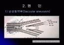 뇌 동  맥 류(Cerebral Aneurysm) 4페이지