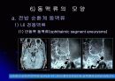 뇌 동  맥 류(Cerebral Aneurysm) 19페이지