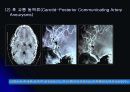 뇌 동  맥 류(Cerebral Aneurysm) 20페이지