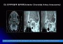 뇌 동  맥 류(Cerebral Aneurysm) 21페이지