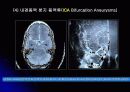 뇌 동  맥 류(Cerebral Aneurysm) 22페이지