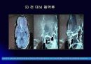뇌 동  맥 류(Cerebral Aneurysm) 23페이지