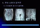 뇌 동  맥 류(Cerebral Aneurysm) 26페이지