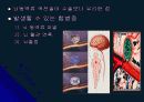 뇌 동  맥 류(Cerebral Aneurysm) 30페이지