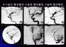뇌 동  맥 류(Cerebral Aneurysm) 31페이지