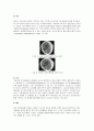 SDH 경막하 혈종 2페이지
