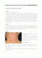 습진(eczema)바로알기 10페이지