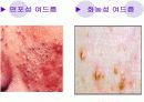 청소년을 대상으로한 여드름 예방 및 치료 교육 발표 9페이지