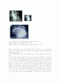 활로 4징 (Tetralogy of Fallot, TOF) 2페이지