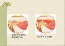 턱관절 장애의 증상과 치료 5페이지
