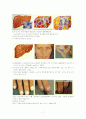 간경화 (Liver Cirrhosis)문헌고찰 간호중재 7페이지