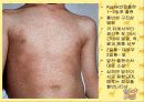 아동간염성 질환 32페이지