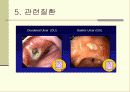 [현대인과 건강]헬리코박터 파이로리의 이해 11페이지