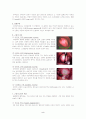 자궁근종 case 2페이지