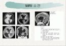 뇌수종 hydrocephalus 14페이지