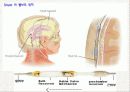 뇌수종 hydrocephalus 16페이지