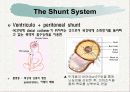뇌수종 hydrocephalus 17페이지