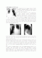 pleural effusion 3페이지