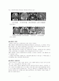 뇌종양 환자 간호 사례연구 case study 2페이지