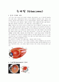 녹내장(Glaucoma)에 대한 정리 3페이지