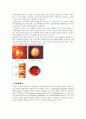 녹내장(Glaucoma)에 대한 정리 4페이지