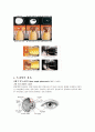 녹내장(Glaucoma)에 대한 정리 7페이지