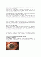 녹내장(Glaucoma)에 대한 정리 13페이지