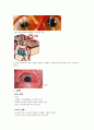 녹내장(Glaucoma)에 대한 정리 15페이지