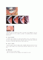 녹내장(Glaucoma)에 대한 정리 25페이지