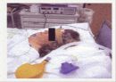 전기경련요법(ECT) 14페이지