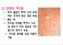 아동 여드름 교육 8페이지