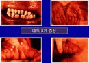 성병의 예방과 치료-치료시 유의점,성병의 종류 14페이지