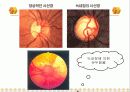 녹내장의 증상 및 치료 4페이지