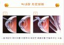 녹내장의 증상 및 치료 23페이지